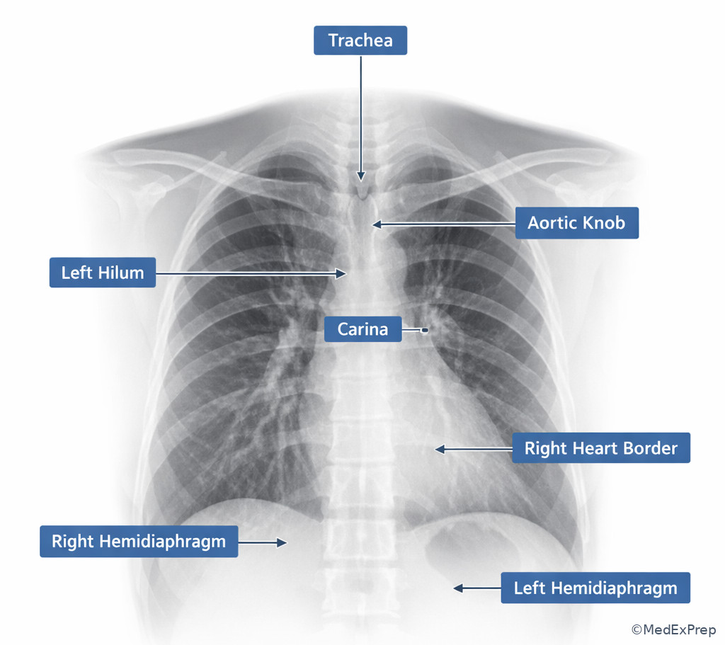 Fig 2. Labeled PA chest radiograph landmarks